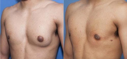 Male Breast Reduction Before & After Gallery - Patient 58218830 - Image 4