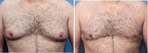 Male Breast Reduction Before & After Gallery - Patient 58219297 - Image 1