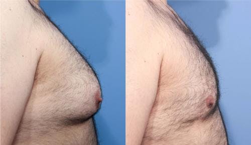 Male Breast Reduction Before & After Gallery - Patient 58219297 - Image 2