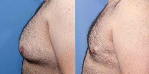 Male Breast Reduction Before & After Gallery - Patient 58219297 - Image 3