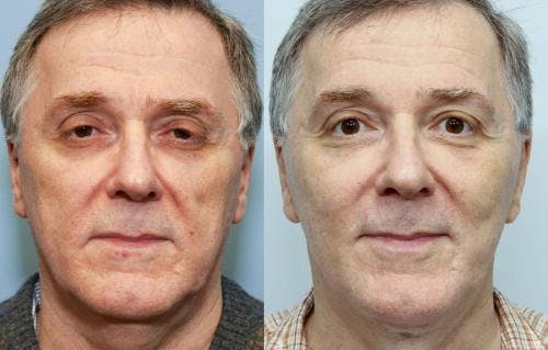 Face Lift Before & After Gallery - Patient 58219299 - Image 3