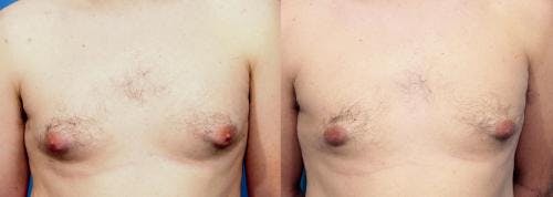 Male Breast Reduction Before & After Gallery - Patient 58219300 - Image 1