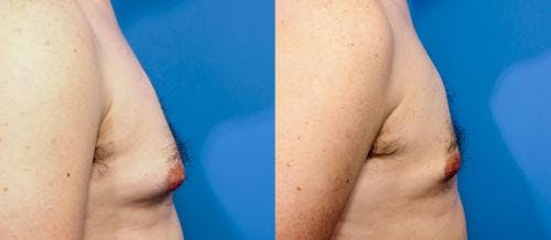 Male Breast Reduction Before & After Gallery - Patient 58219300 - Image 2