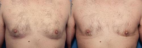 Male Breast Reduction Before & After Gallery - Patient 58219783 - Image 1