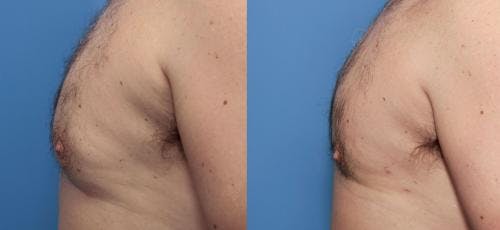 Male Breast Reduction Before & After Gallery - Patient 58219783 - Image 2