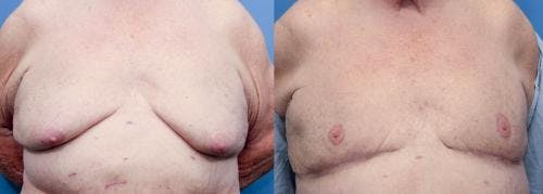 Male Breast Reduction