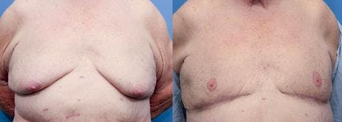 Male Breast Reduction Before & After Gallery - Patient 58220263 - Image 1