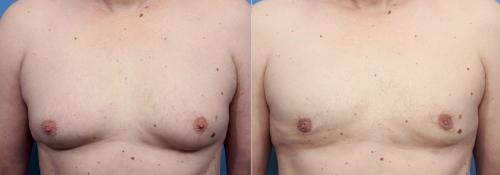 Male Breast Reduction Before & After Gallery - Patient 58220265 - Image 1