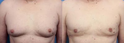 Male Breast Reduction Before & After Gallery - Patient 58220265 - Image 1