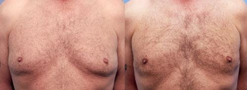 Male Breast Reduction Before & After Gallery - Patient 58220266 - Image 1