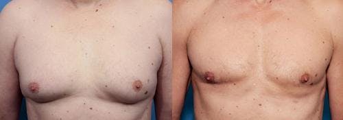 Male Breast Reduction Before & After Gallery - Patient 58220737 - Image 1