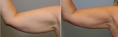 Arms Before & After Gallery - Patient 149385353 - Image 1