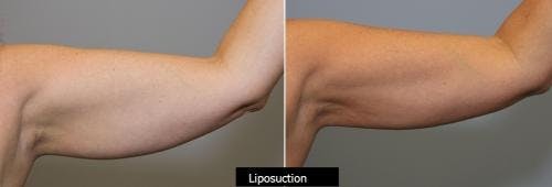 Arms Before & After Gallery - Patient 149385353 - Image 2