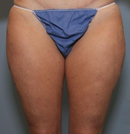 Thighs Before & After Gallery - Patient 149385418 - Image 1