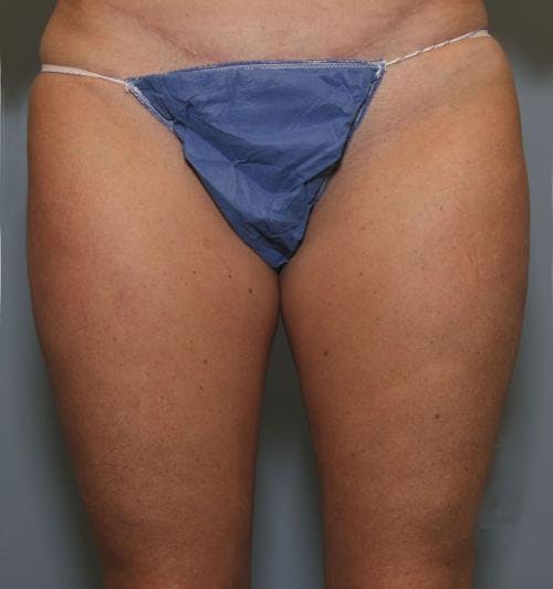 Thighs Before & After Gallery - Patient 149385418 - Image 2