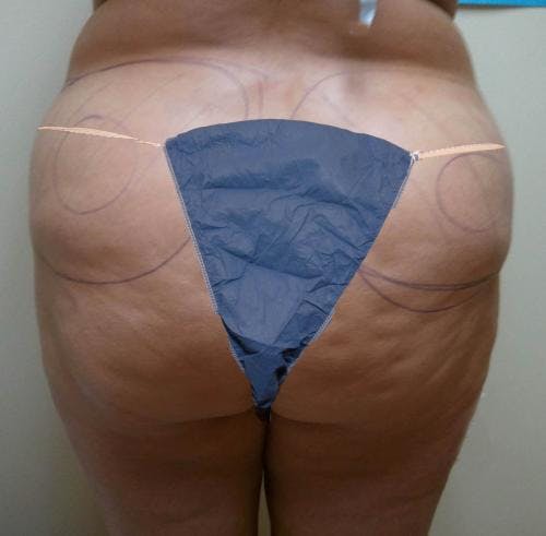 Hips Before & After Gallery - Patient 149385337 - Image 1