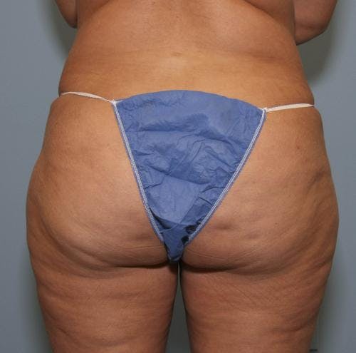 Hips Before & After Gallery - Patient 149385337 - Image 2