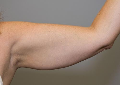 Arms Before & After Gallery - Patient 149385355 - Image 1