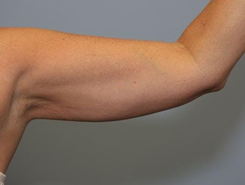 Arms Before & After Gallery - Patient 149385355 - Image 2