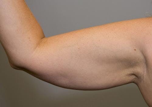 Arms Before & After Gallery - Patient 149385355 - Image 3