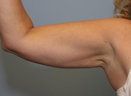 Arms Before & After Gallery - Patient 149385355 - Image 4