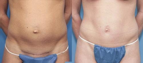 Tummy Tuck Before & After Gallery - Patient 58470037 - Image 1