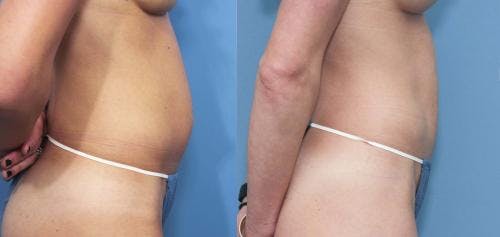 Tummy Tuck Before & After Gallery - Patient 58470037 - Image 2