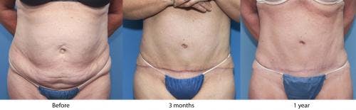 Tummy Tuck Before & After Gallery - Patient 58470044 - Image 1