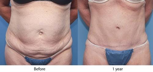 Tummy Tuck Before & After Gallery - Patient 58470044 - Image 2