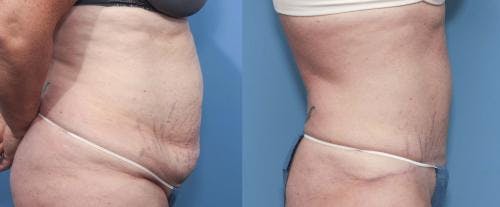 Tummy Tuck Before & After Gallery - Patient 58470044 - Image 3