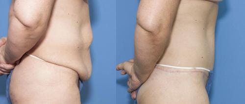 Tummy Tuck Before & After Gallery - Patient 58470045 - Image 2