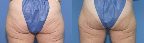 Tummy Tuck Before & After Gallery - Patient 58470045 - Image 3