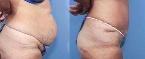 Tummy Tuck Before & After Gallery - Patient 58470046 - Image 2