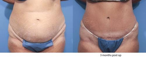 Tummy Tuck Before & After Gallery - Patient 58470046 - Image 1