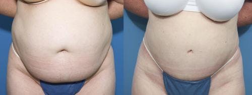 Tummy Tuck Before & After Gallery - Patient 58470047 - Image 1