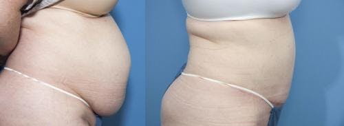 Tummy Tuck Before & After Gallery - Patient 58470047 - Image 2