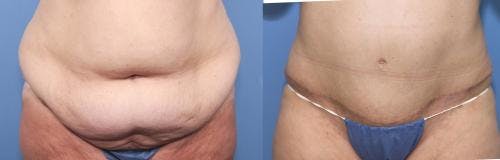 Tummy Tuck Before & After Gallery - Patient 58470048 - Image 1