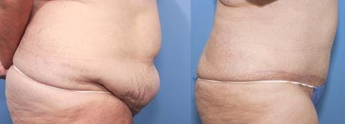 Tummy Tuck Before & After Gallery - Patient 58470048 - Image 2
