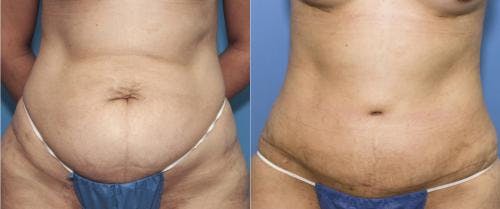 Tummy Tuck Before & After Gallery - Patient 58470049 - Image 1