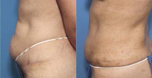 Tummy Tuck Before & After Gallery - Patient 58470049 - Image 2