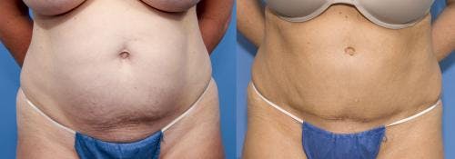 Tummy Tuck Before & After Gallery - Patient 58470050 - Image 1