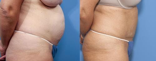 Tummy Tuck Before & After Gallery - Patient 58470050 - Image 2