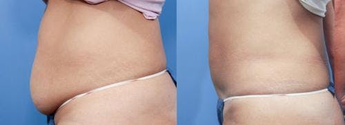Tummy Tuck Before & After Gallery - Patient 58470052 - Image 2