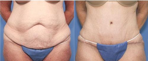 Tummy Tuck Before & After Gallery - Patient 58470053 - Image 1