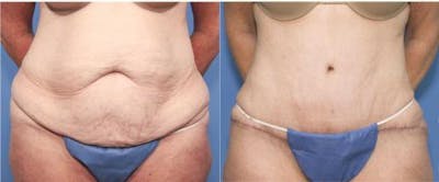 Tummy Tuck Before & After Gallery - Patient 58470053 - Image 1