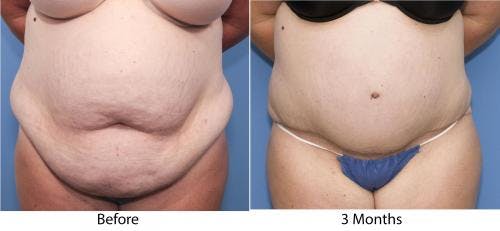 Tummy Tuck Before & After Gallery - Patient 58470054 - Image 1