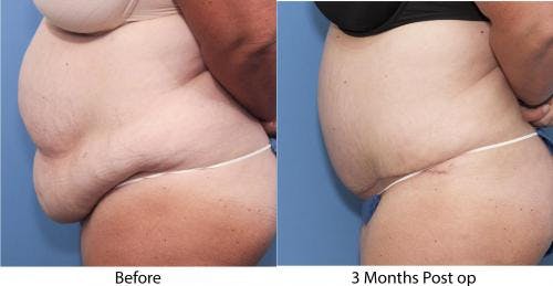 Tummy Tuck Before & After Gallery - Patient 58470054 - Image 2