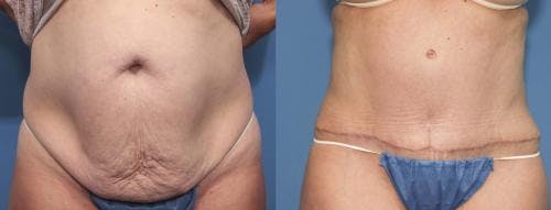 Tummy Tuck Before & After Gallery - Patient 58470056 - Image 1