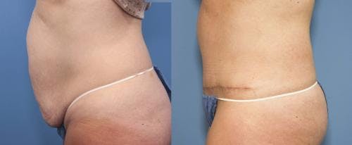 Tummy Tuck Before & After Gallery - Patient 58470056 - Image 2