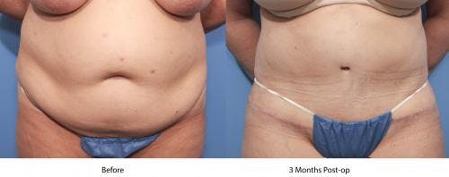 Tummy Tuck Before & After Gallery - Patient 58470057 - Image 1